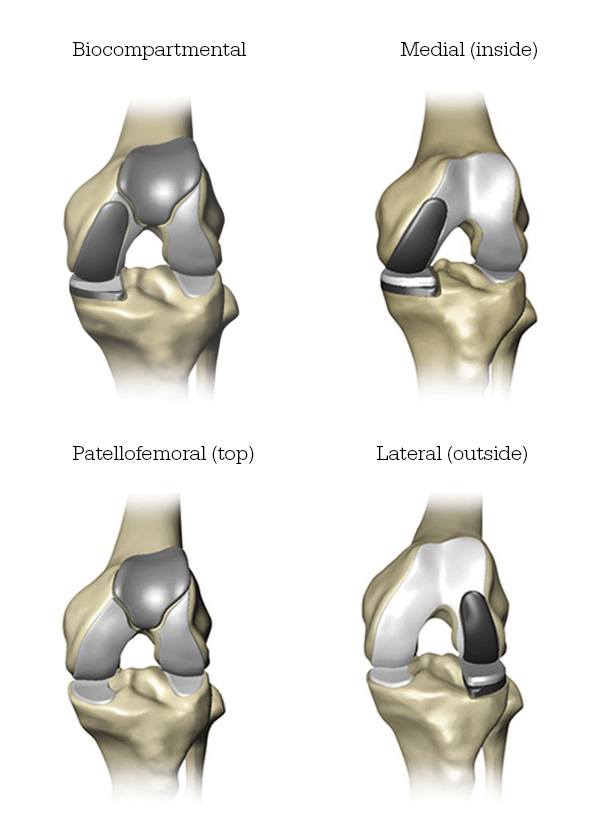 Partial Knee Replacement